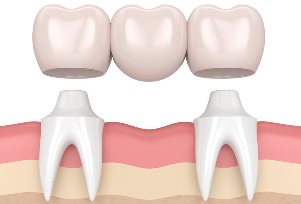Treatment - Vertue Dental