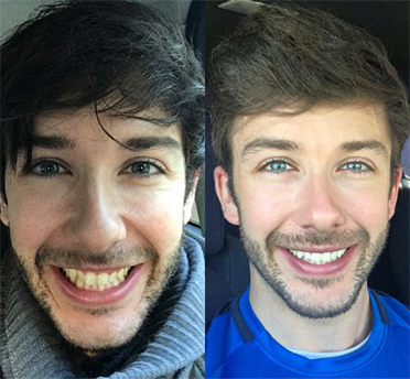 Invisalign – before & after results