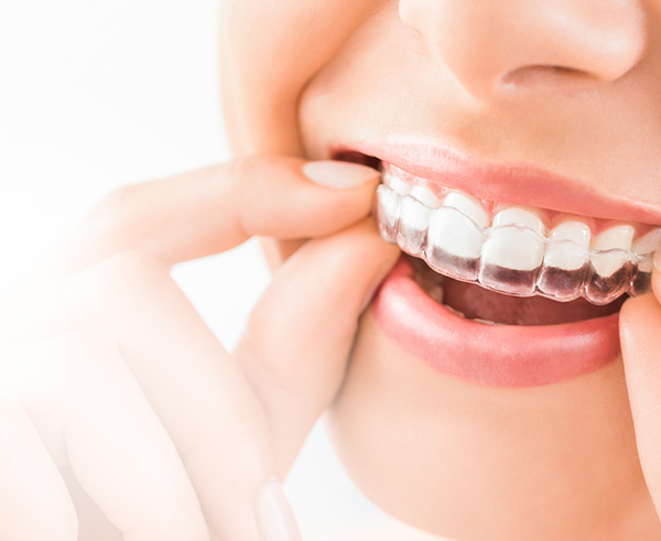 Cosmetic Dentist in Pinner: Invisalign Teeth Braces Pinner